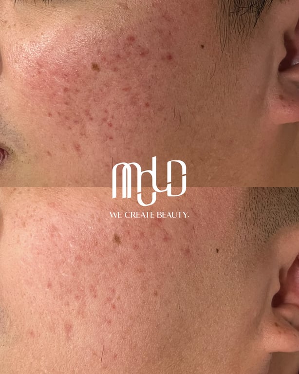 Acne Scar Treatment Options in the Philippines: What Medical Experts Say Works Best